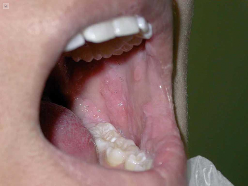 Enfermedades de Mucosa Oral y Genital