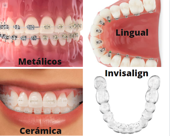 tipos-ortodoncia