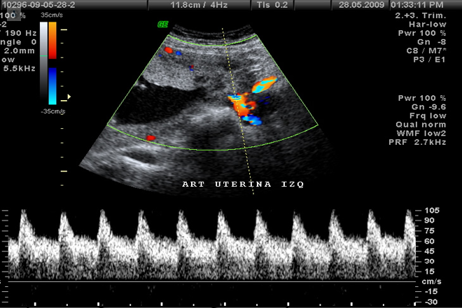 Doppler fetal, doppler placentario