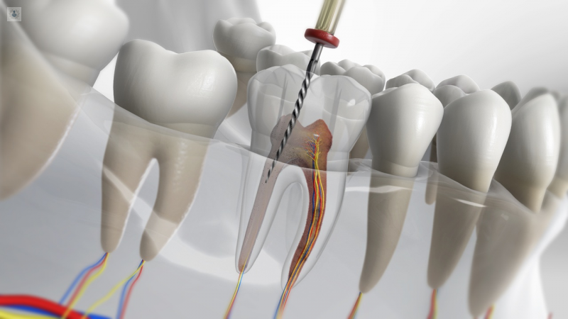 endodoncia