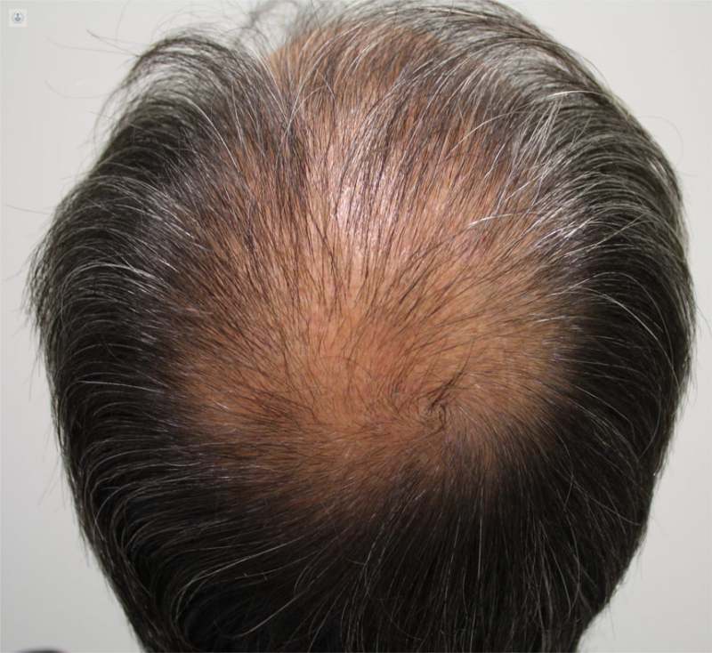 alopecia