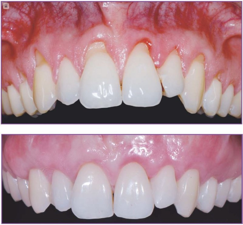 cirugía-periodontal