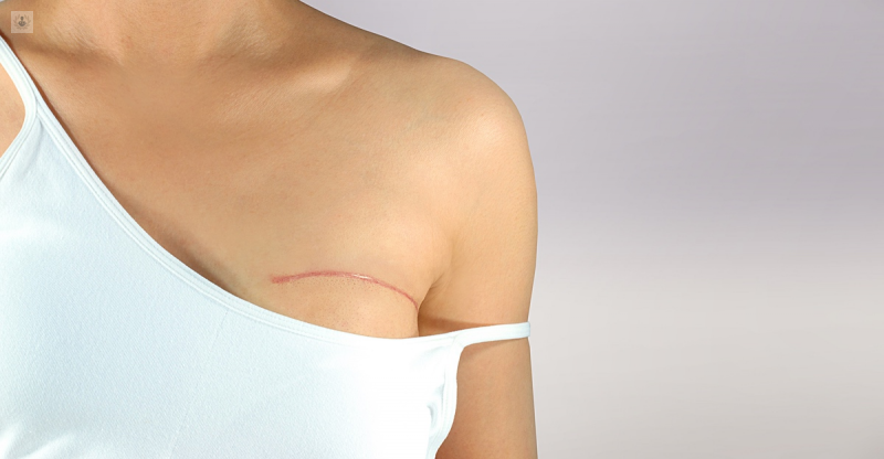 reconstrucción mamaria