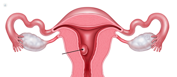 polipos-endometriales