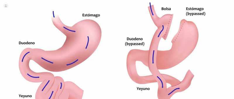 bypass-gastrico