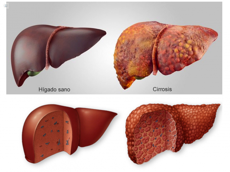 cirrosis del higado vs higado sano