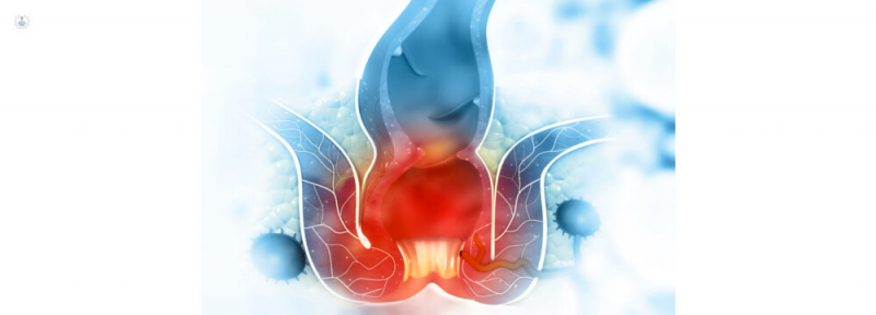 Cirugía de Fístula Anorrectal Compleja con Láser