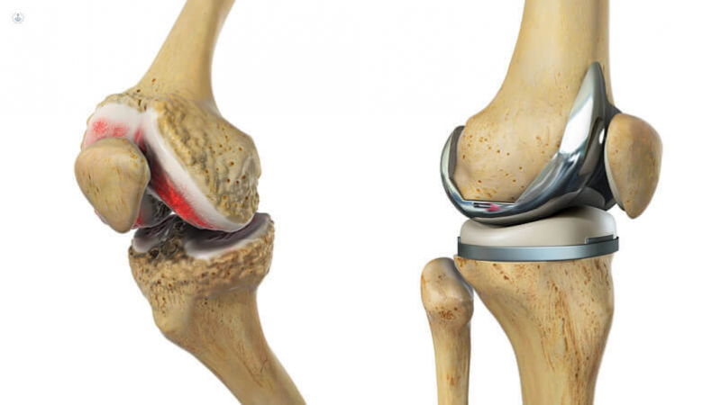 Prótesis de Rodilla