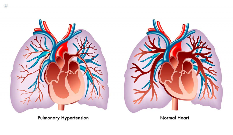 Hipertensión Pulmonar