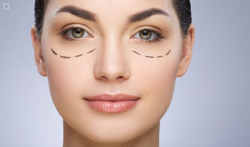 Blefaroplastia