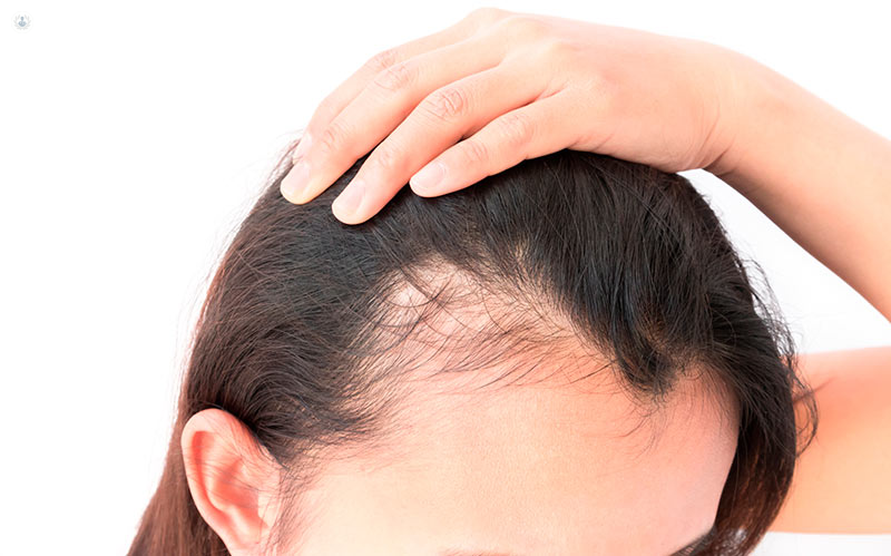 alopecia-femenina