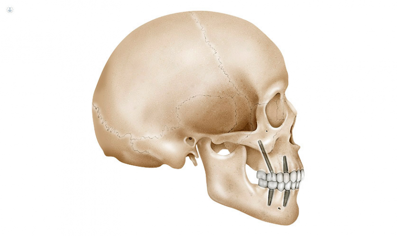 Implantes Dentales Pterigoideos