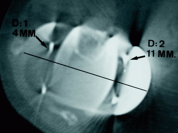 TAC Articular en Movimiento 