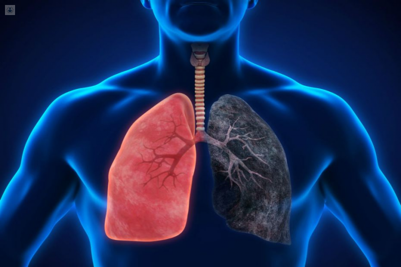 enfisema-pulmonar