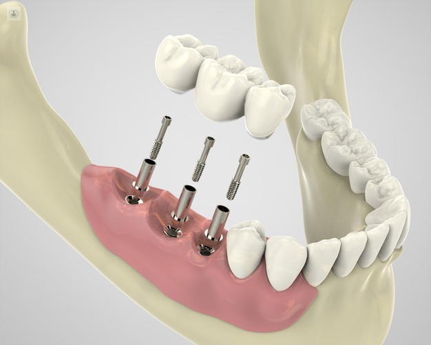 Implantes de Carga Inmediata