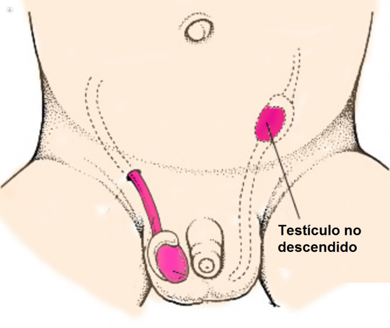 Testículo no Descendido