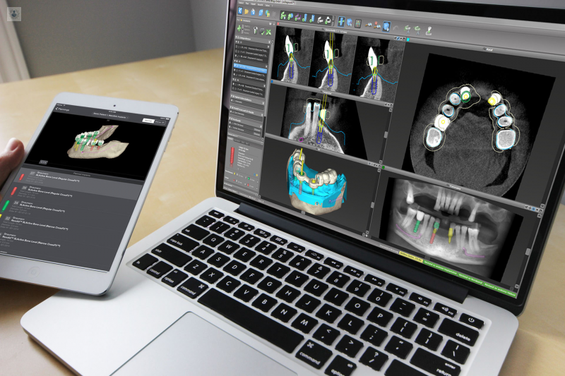 Planificación 3D para Implantología