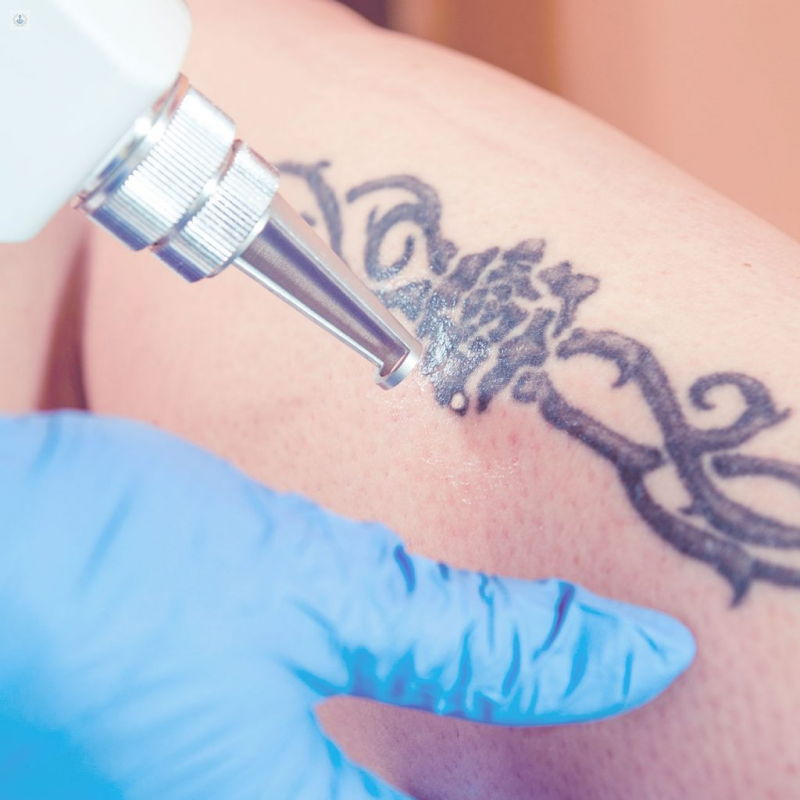 Eliminación de Tatuajes con Láser: qué es, síntomas y tratamiento | Top  Doctors