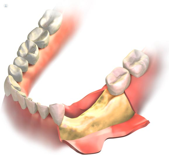 injerto-óseo-dental