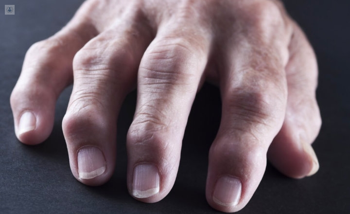 Artrosis de la mano - Osteoarthritis