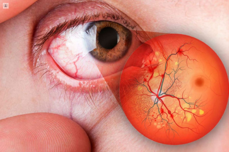 enfermedades-de-retina