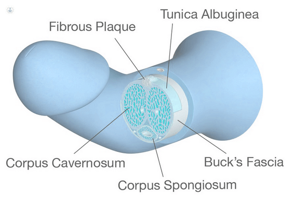 Fibrosis Traumática del pene