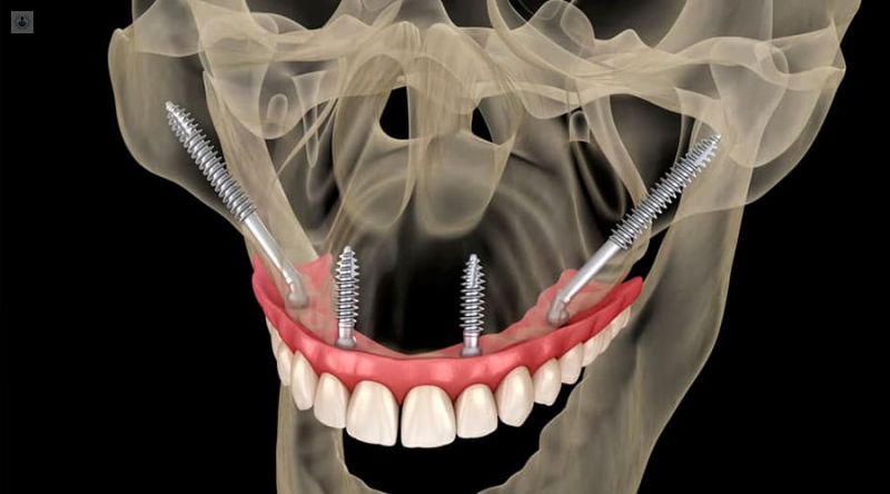 implantes-dentales-cigomáticos