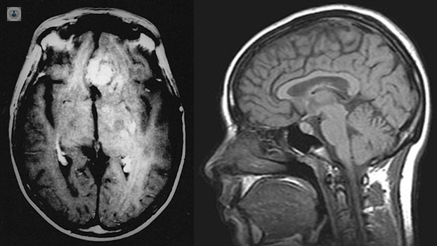 tumores-cerebrales