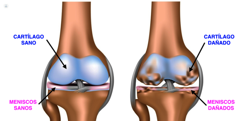 Ejercicios para la artrosis de rodilla