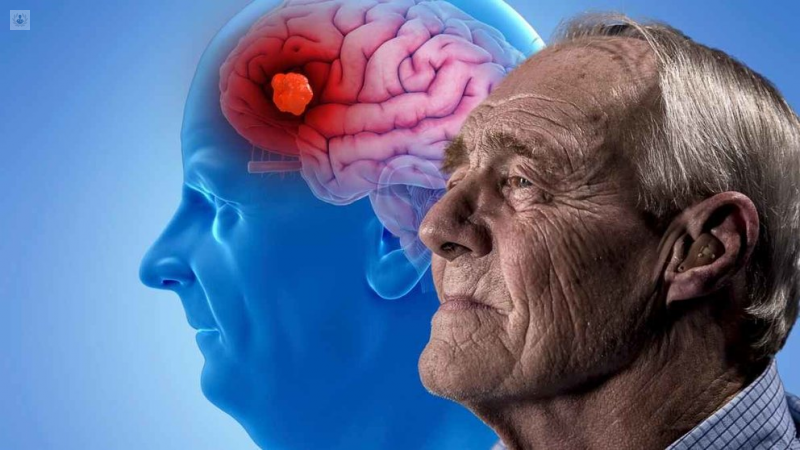 Enfermedad del Alzheimer por muerte de Neuronas.