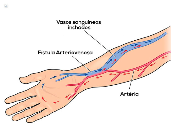 Fistula arteriovenosa