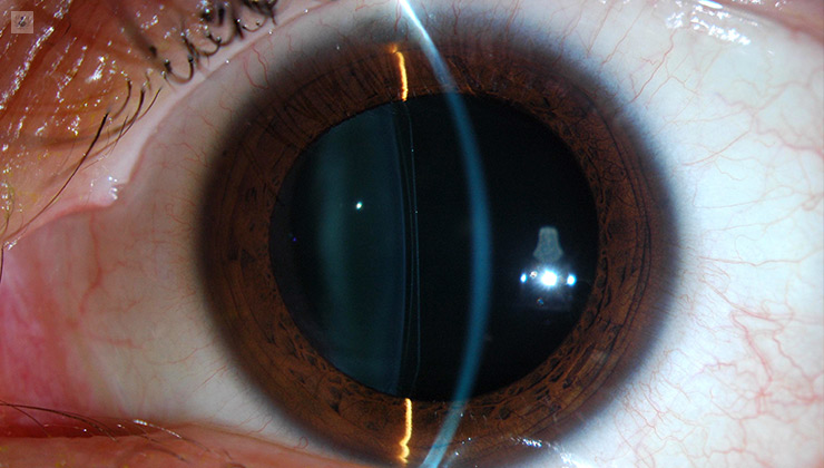 Lentes Intraoculares