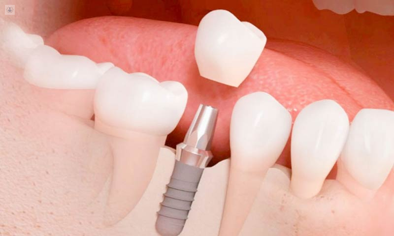 Implantes Dentales