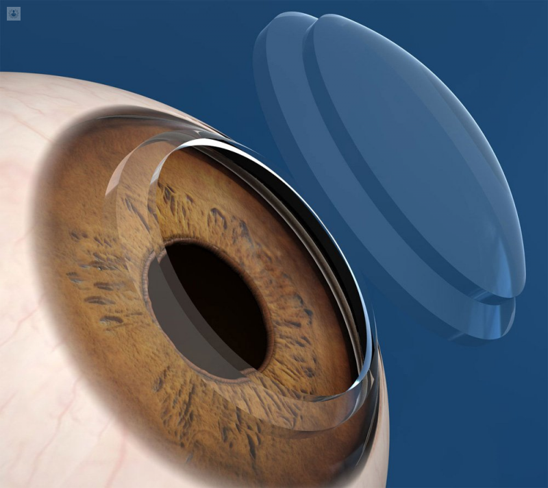 trasplante-endotelio-corneal