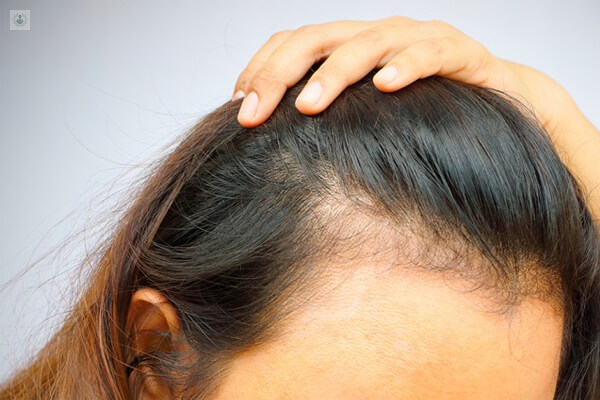 Alopecia Femenina