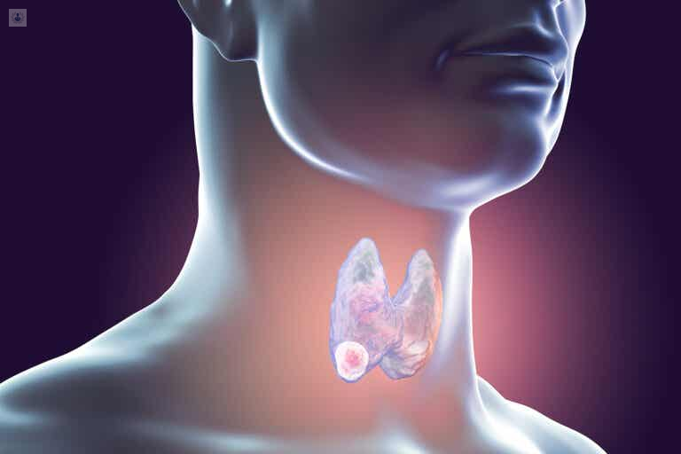 cancer de tiroides 