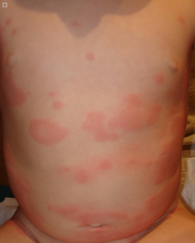 Alergia Pediatrica
