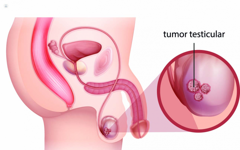 tumor testicular