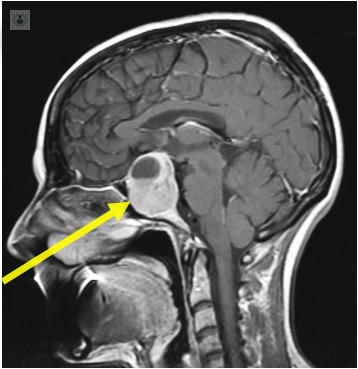 tumores-hipofisiarios