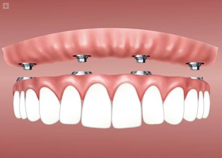 Implantes Dentales