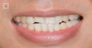 Fractura Dental