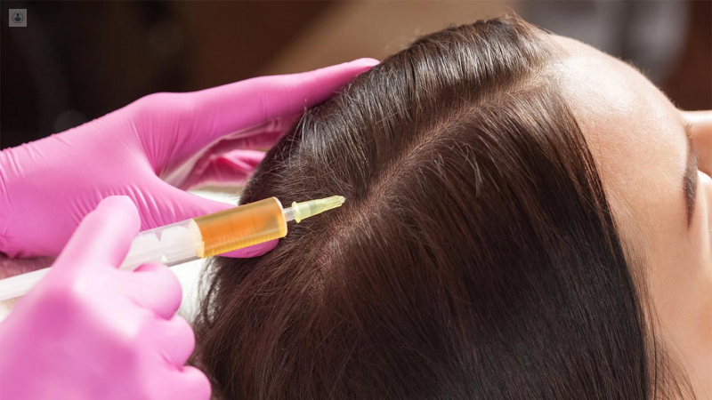Lógico Tutor cortar Plasma Rico en Plaquetas como tratamiento para la Alopecia | Top Doctors