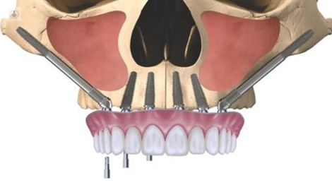 Implantes Cigomáticos