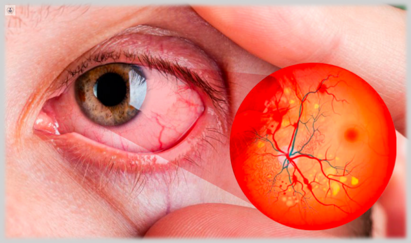 Retinopatía Diabética