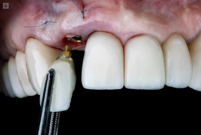 Implantes Dentales