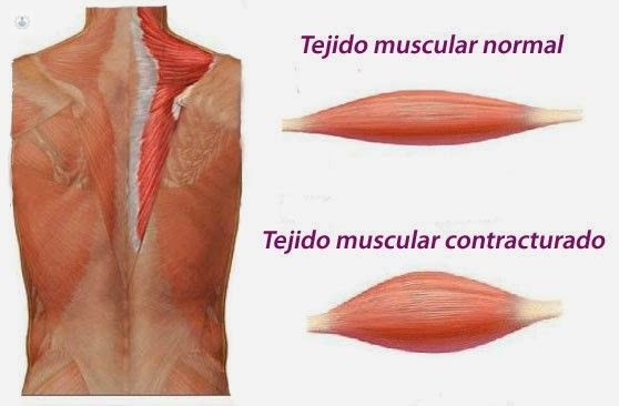 contractura muscular