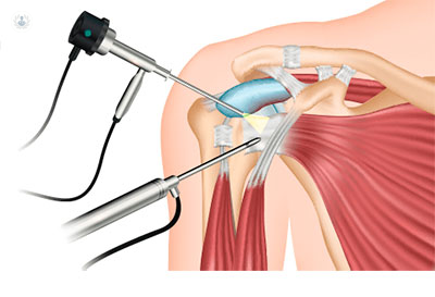 Cirugía Artroscópica