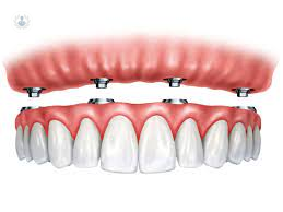 Implantes Dentales de carga inmediata