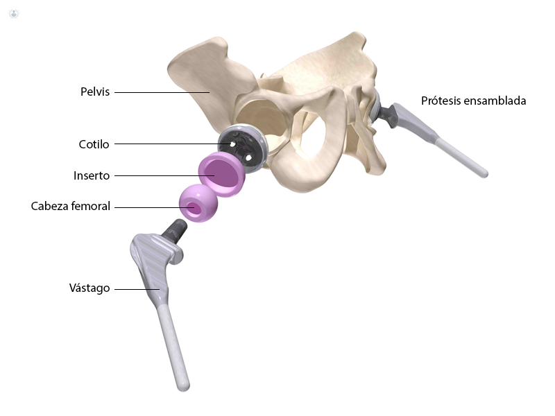 cirugía-prótesis-de-cadera