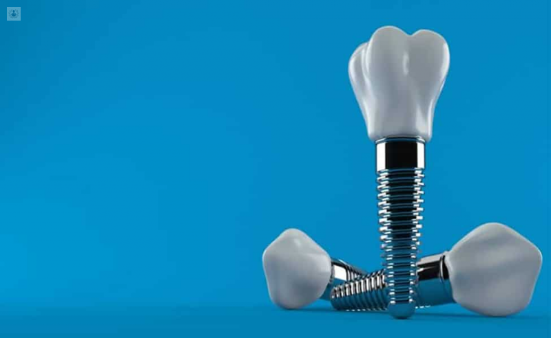 Implantes Dentales